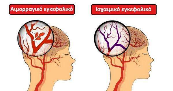 Εγκεφαλικό